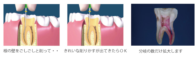 深い虫歯-10