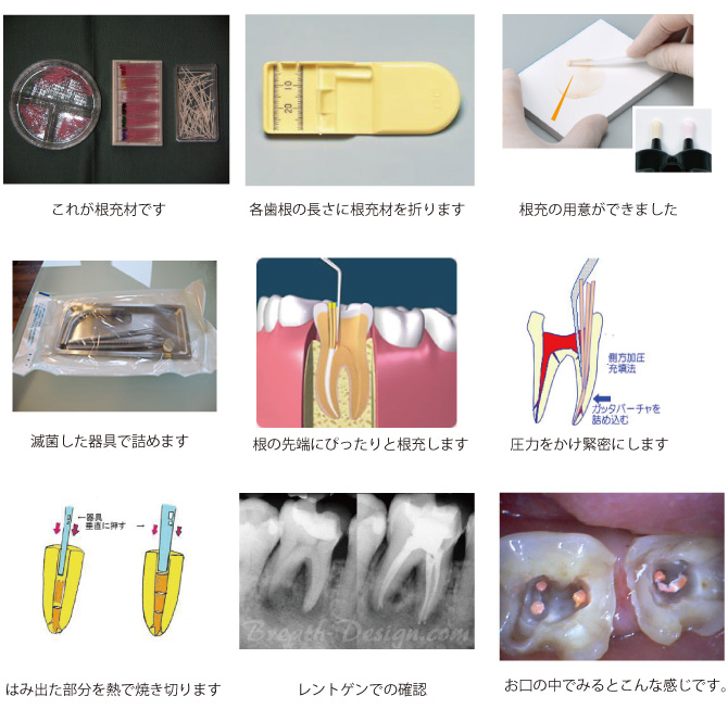 深い虫歯 インプラント 矯正歯科 小児歯科の医療法人横浜歯友会内藤歯科