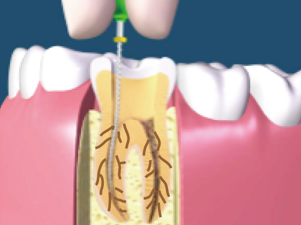 深い虫歯-13