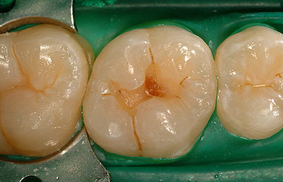 浅い虫歯-3