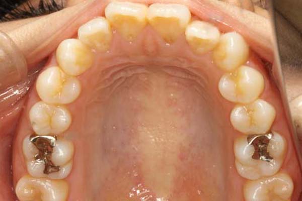 浅い虫歯-15