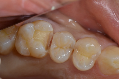 浅い虫歯-18