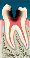 深い虫歯-1