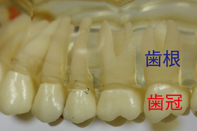 深い虫歯-14