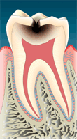 浅い虫歯