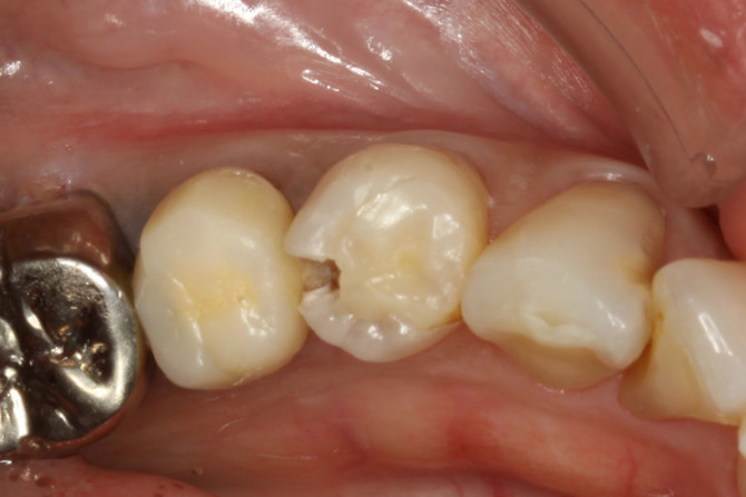 奥歯の隣接面を含む虫歯
