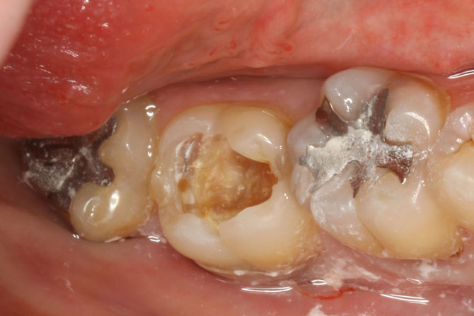 奥歯の隣接面を含まない虫歯